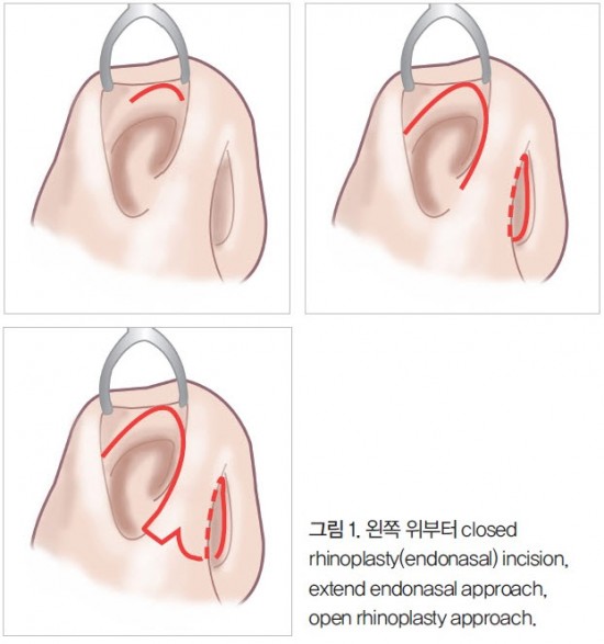 closed rhinoplasty Doctor Tae Joo Ahn